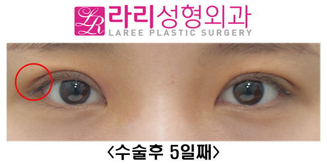 [Lari Plastic Surgery] Revision Double Eyelid Surgery to Correct Mucosal Exposure Caused by Sausage-Like Eyelids image 4