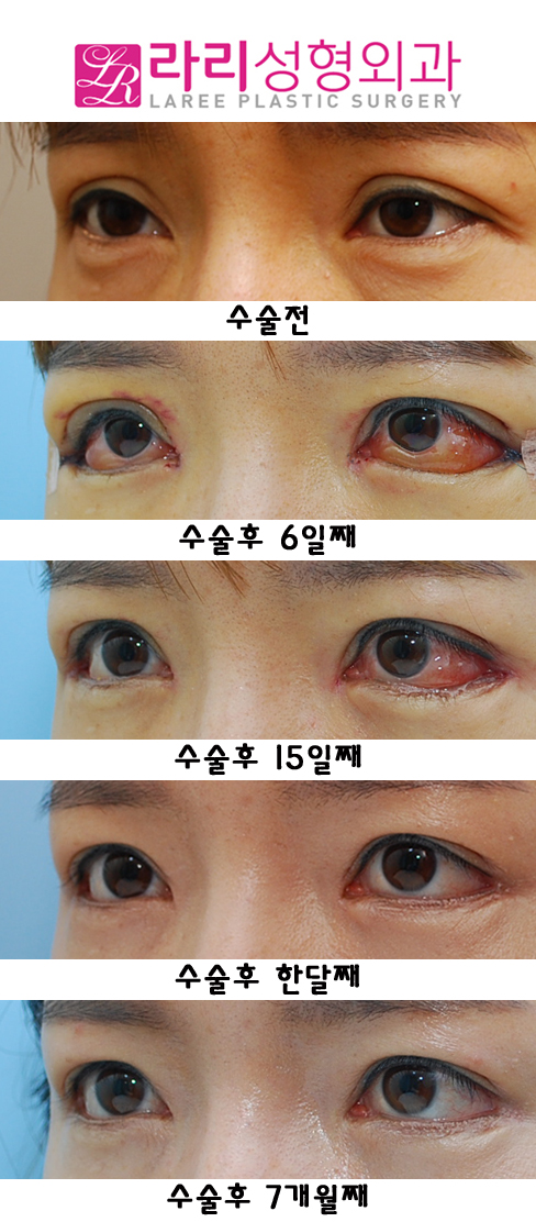 Sausage Correction, Epicanthoplasty, and Revision Surgery for Lateral Canthoplasty with Lowered Outer Eye Corners image 3
