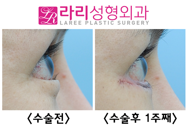 [Lari Plastic Surgery] Lower blepharoplasty including entropion correction, the most common cause of iatrogenic ectropion image 3