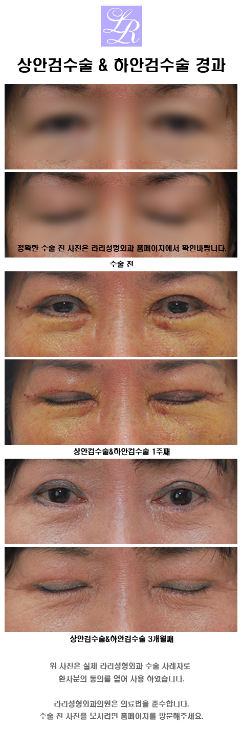 Upper Blepharoplasty and Lower Blepharoplasty image 5