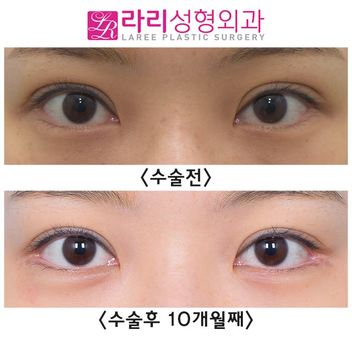 [Lari Plastic Surgery] Before-and-After Photos of Double Eyelid Revision Surgery and Lateral Canthoplasty Revision Surgery That Leave Nothing Out image 1