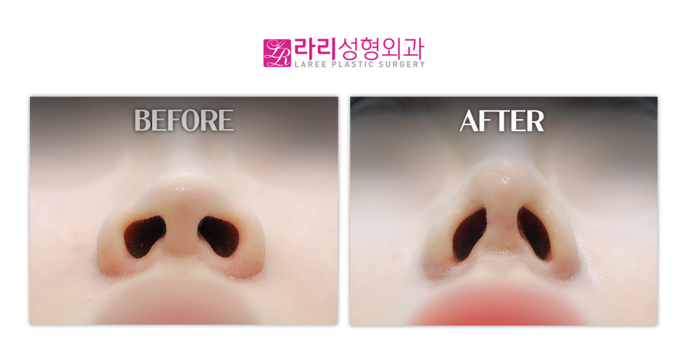 [Lari Plastic Surgery] Bridge Augmentation, Tip Plasty (Septal Cartilage), Hump Correction, Lateral Osteotomy, Alar Reduction image 4