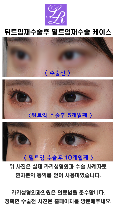 뒤트임재수술 하고나서 밑트임재수술 가능할까 관련 이미지 3