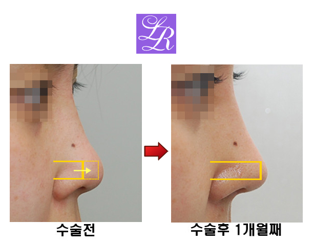 코재수술 코끝을 오똑하게 관련 이미지 5
