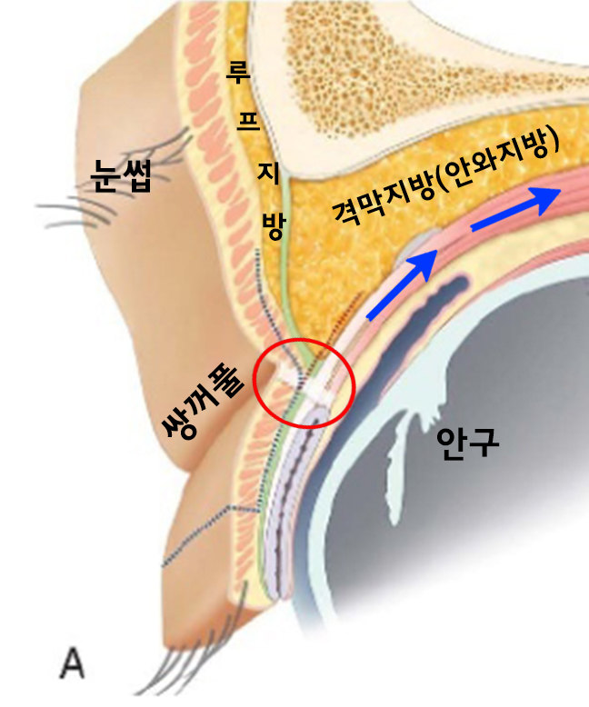 [라리성형외과] 쌍꺼풀없애기 수술 눈안감김(토안)의 원인이 정말 피부절제 때문일까? - 무절제쌍꺼풀없애기 관련 이미지 3