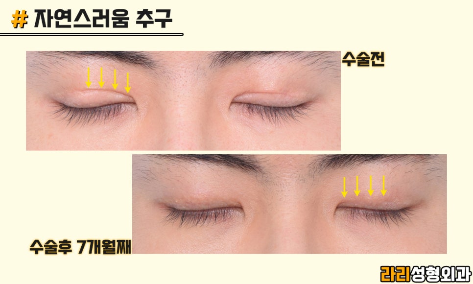 [Lari Plastic Surgery] Men’s Eye Surgery, Trends and Desired Look - Monolid & Hidden Double Eyelid image 9
