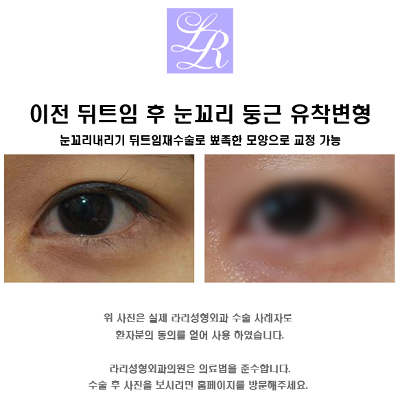 뒤트임재수술 - 안검내반 교정, 2주와 4개월, 1년 경과 관련 이미지 4