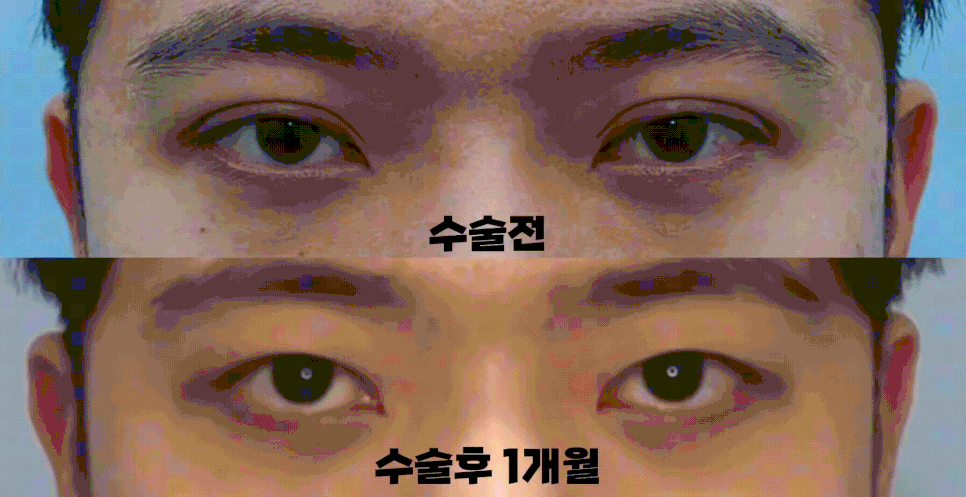 [라리성형외과] 쌍꺼풀없애기 무쌍수술, 자연스러운 변화와 눈 깜빡임을 확인하세요. 관련 이미지 5