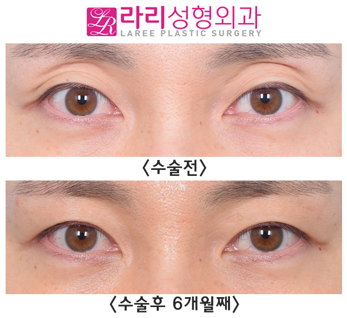 [라리성형외과] 절개쌍꺼풀없애기 + 윗눈꺼풀지방이식, 6개월 차 수술 전후 경과 사진 관련 이미지 1