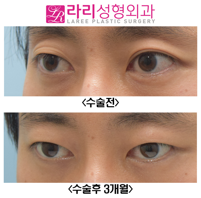 [라리성형외과] 쌍꺼풀없애기와 함께 한 윗눈꺼풀 패임 교정, 눈두덩이(Roof) 지방이식수술 전후사진 관련 이미지 4
