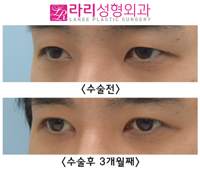 [라리성형외과] 붓기 최소화하는 자연스러운 속쌍꺼풀 남자 절개눈매교정 앞트임수술 전후사진 관련 이미지 3