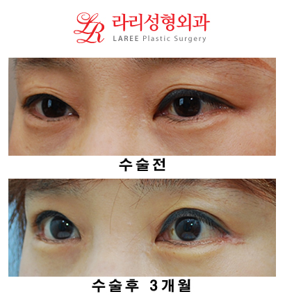 Revision Eyelid Surgery, Cases That Need Ptosis Correction, Correcting Asymmetry in Uneven Eyes image 4