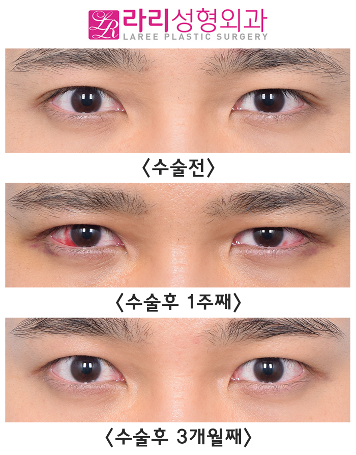 [라리성형외과] 자연쌍꺼풀없애기 수술 전후 사진 회복 기간 짝눈 교정 관련 이미지 3