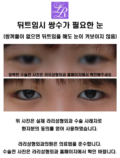 뒤트임 눈매교정 함께 관련 이미지 1