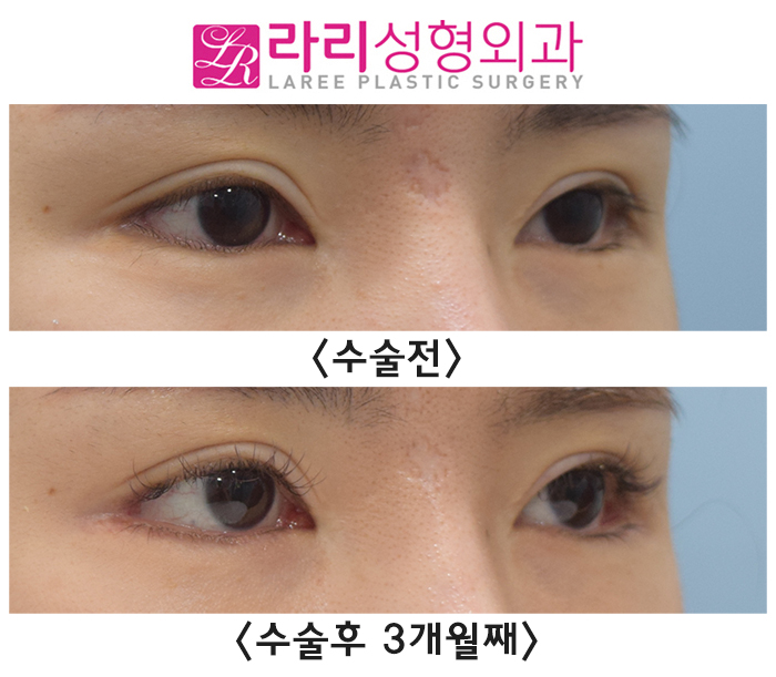 [라리성형외과] 완성도 높은 뒤트임수술을 위해 애교이식지방은 제거해 주세요. (필요시 안검내반수술을 함께) 관련 이미지 3