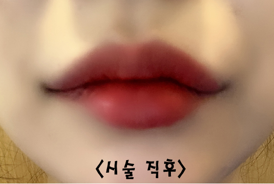 How to Make the Corners of the Mouth Lift Beautifully with Lip Corner Filler image 8