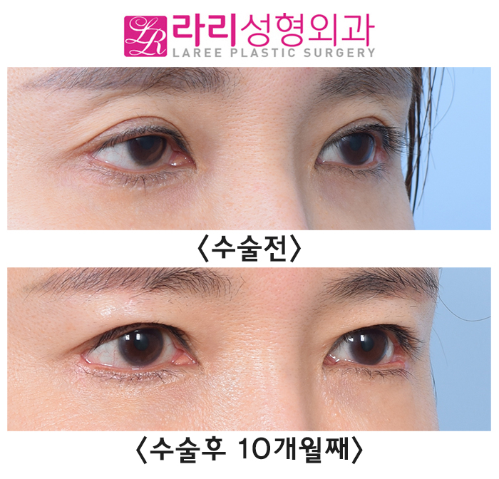 [Lari Plastic Surgery] Sunken Upper Eyelids -> Loop Fat Grafting -> Before-and-After Sunken-Eye Correction Photos image 3