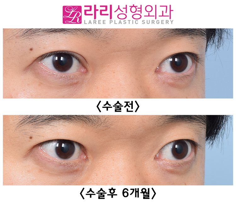 [Lari Plastic Surgery] The Best Time for Eyelid Revision Surgery: Before-and-After of Incisional Double Eyelid Surgery and Double Eyelid Removal Surgery Done One Year Ago image 1