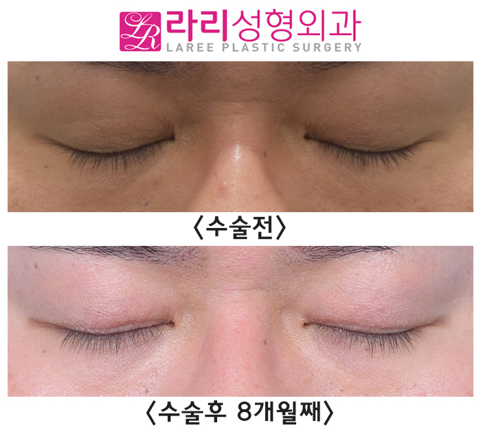 [Lari Plastic Surgery] Double Eyelid Removal Surgery That Completely Removes the Double Eyelid Line image 4