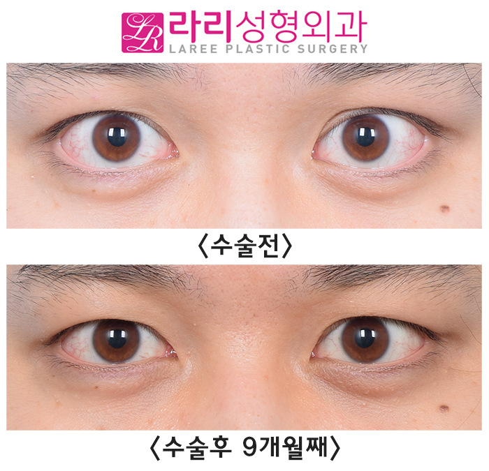 [Rari Plastic Surgery] Natural-looking eyelid correction surgery before-and-after photos that can look natural at any gaze angle (+forehead Botox) image 6