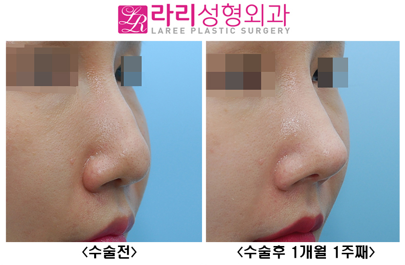 [Rari Plastic Surgery] Nose Bridge and Tip Surgery After Hyco Removal image 2