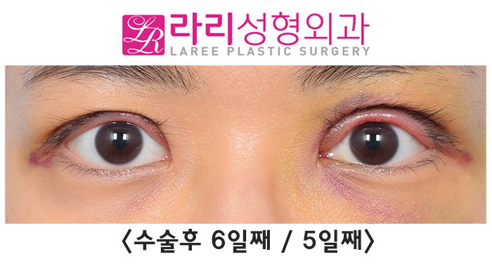[라리성형외과] 겹주름 쌍꺼풀을 잘 없애려면 피할 수 없는 상안검외반, 좋아질 수 있어요. 관련 이미지 4