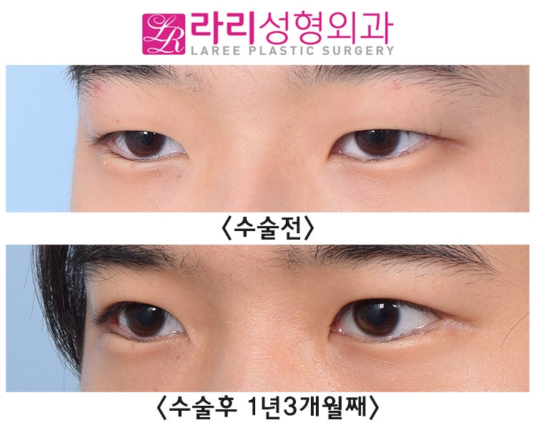 [Lari Plastic Surgery] Incisional Eyelid Correction + Lateral Canthoplasty for Men, and Before-and-After Photos of Hump Nose Osteotomy Surgery Using Ear Cartilage and Septal Cartilage image 3