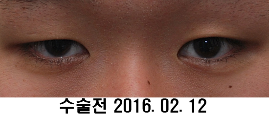 Before and After: Sharper Male Eye Correction (feat. Video) image 6