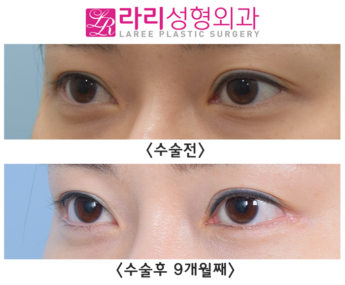 [Lari Plastic Surgery] The first surgery progress for outer corner lowering canthoplasty is good. image 2