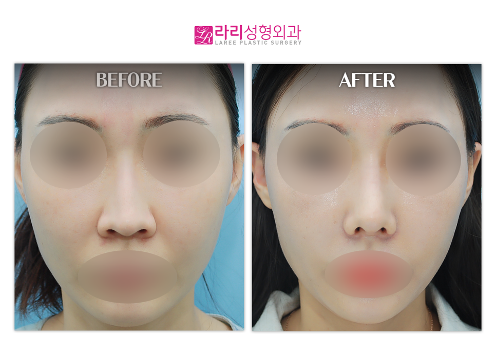 [Lari Plastic Surgery] Bridge Augmentation, Tip Plasty (Septal Cartilage), Hump Correction, Lateral Osteotomy, Alar Reduction image 1