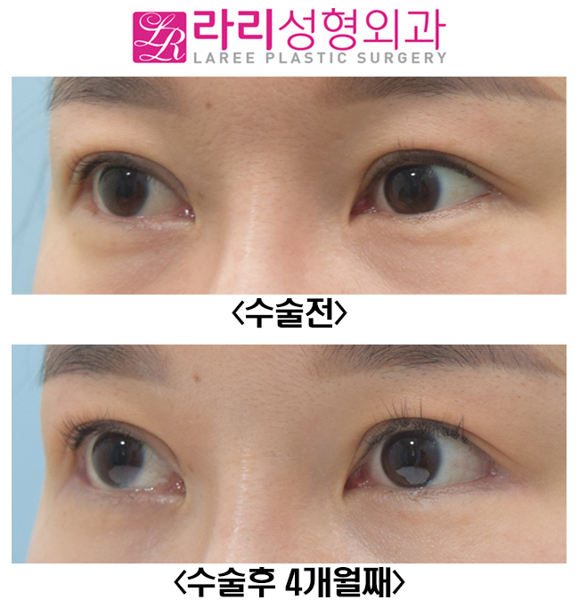 [라리성형외과] 밑트임복원, 뒤트임재수술 전후 사진 관련 이미지 3