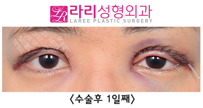 [라리성형외과] 겹주름 쌍꺼풀을 잘 없애려면 피할 수 없는 상안검외반, 좋아질 수 있어요. 관련 이미지 2