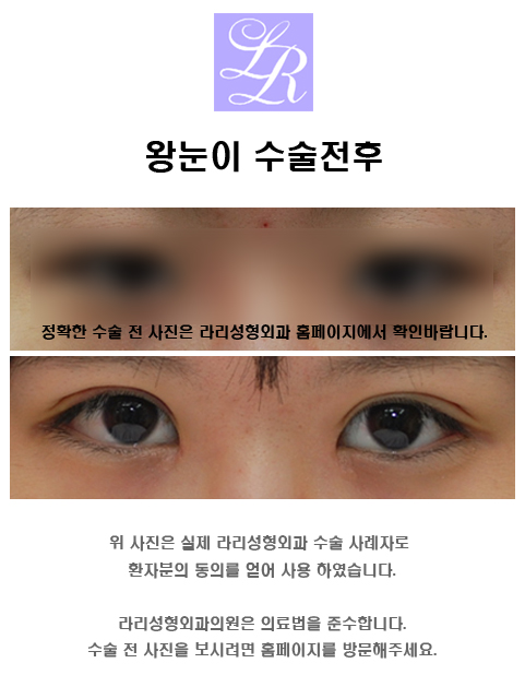 Small Eyes Surgery That Makeup Can’t Fix - Big-Eye Surgery image 2