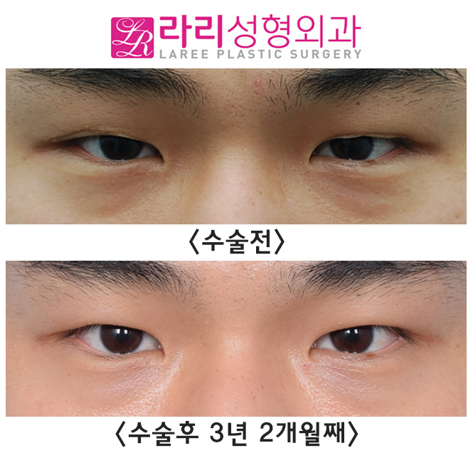 [라리성형외과] 절개 쌍꺼풀 부작용 풀림 현상 쌍꺼풀없애기 수술로 말끔하게 관련 이미지 1