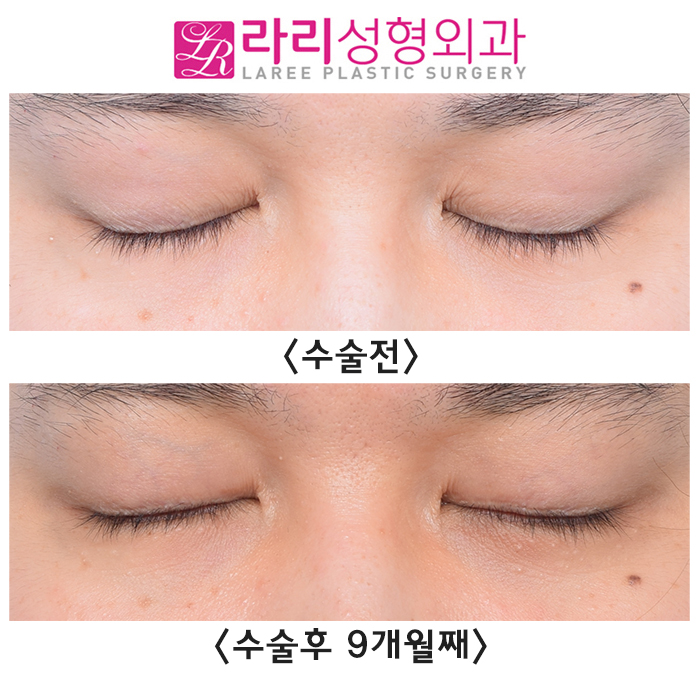 [Rari Plastic Surgery] Natural-looking eyelid correction surgery before-and-after photos that can look natural at any gaze angle (+forehead Botox) image 3
