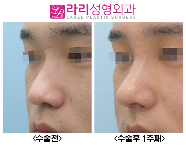[Lari Plastic Surgery] Before-and-After Photos of Male Rhinoplasty with Rib Cartilage image 4