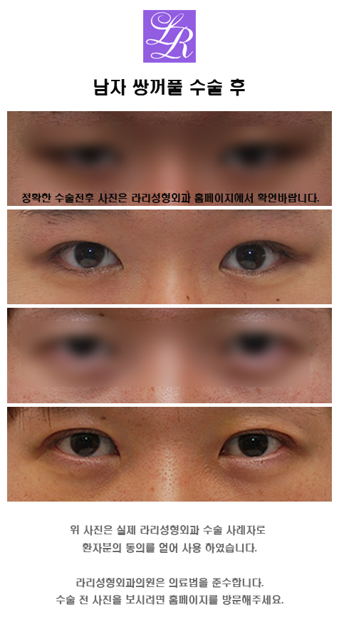 Male Epicanthoplasty - Can It Be Done Together with Canthoplasty? image 1
