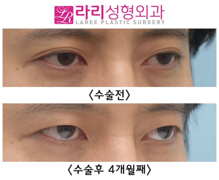[라리성형외과] 자연쌍꺼풀 지워서 무쌍꺼풀 만드는 눈 수술 전후 사진 관련 이미지 1