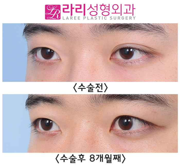 [라리성형외과]  한쪽만 진한 자연쌍꺼풀, 쌍꺼풀없애기 양쪽 다 수술한 전후사진 관련 이미지 2
