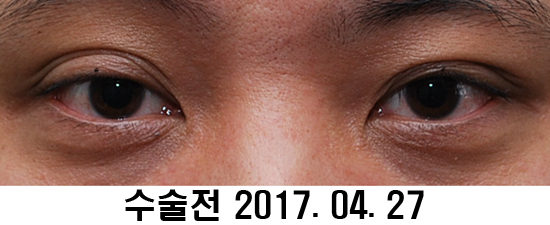 Before and After: Sharper Male Eye Correction (feat. Video) image 9