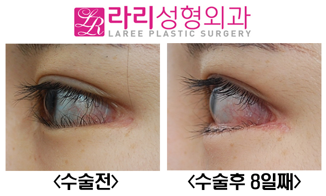 [라리성형외과] 속눈썹찔림, 안검내반교정수술이 필요할 때. 관련 이미지 3