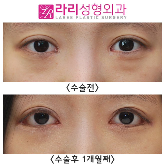 [라리성형외과] 앞트임재수술, 뒤트임재수술, 눈밑지방재배치 수술 한달경과 전후사진 관련 이미지 1