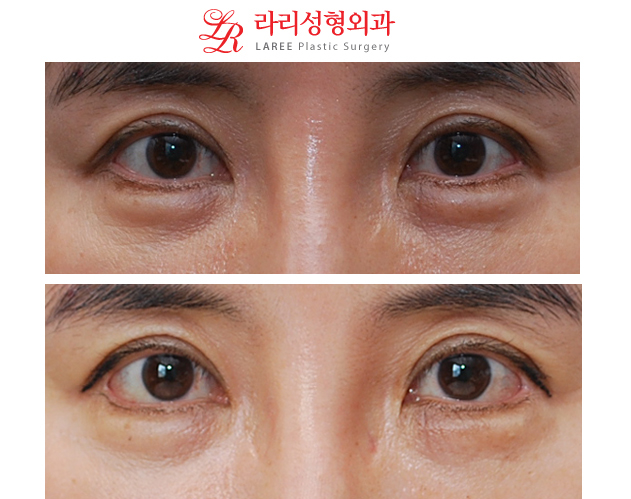 꽃중년 바비밑트임 수술전후사진 관련 이미지 1