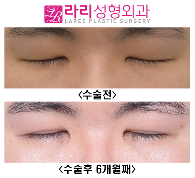[Lari Plastic Surgery] The Effect of Double Eyelid Incision Ptosis Correction That Opens Unopened Eyes Wide image 3