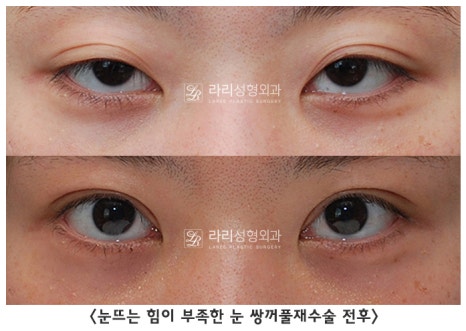 [라리성형외과] 쌍꺼풀수술 그리고 쌍꺼풀재수술 , 성공하려면 어디서 해야 할까요 !? 관련 이미지 7