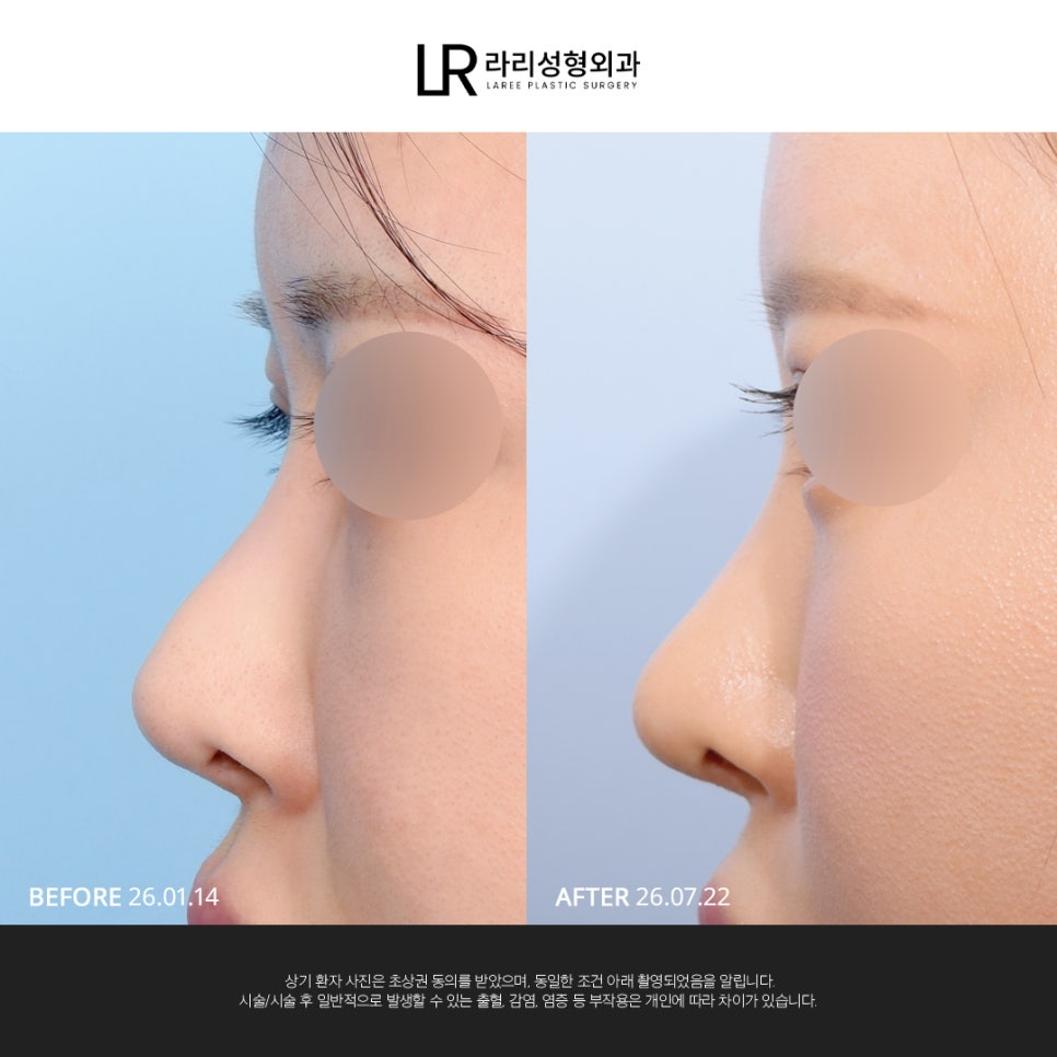[LARI Plastic Surgery] Structural Line Rhinoplasty Revision Connecting the Nasal Bridge, Dorsum, and Tip image 6