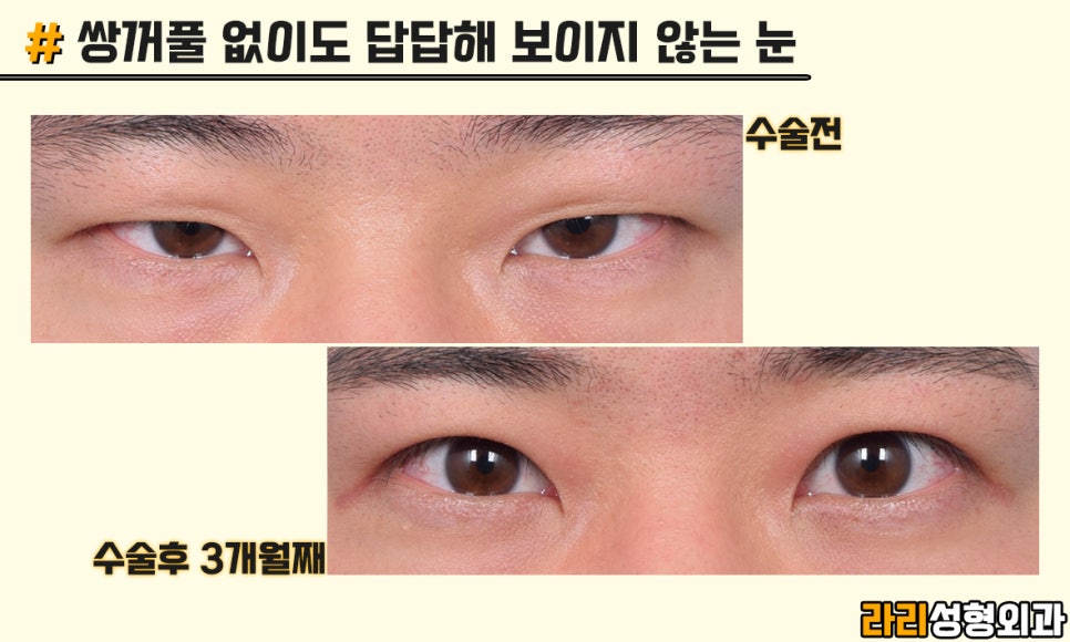 [Lari Plastic Surgery] Men’s Eye Surgery, Trends and Desired Look - Monolid & Hidden Double Eyelid image 6