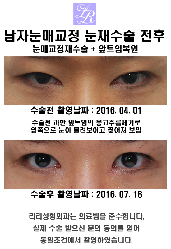 Male Epicanthoplasty - Can It Be Done Together with Canthoplasty? image 3