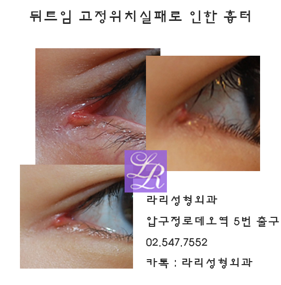 뒤트임 재수술 할때 눈꼬리 흉터 걱정쓰 관련 이미지 2