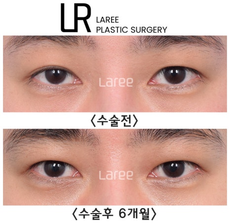 [라리성형외과] 쌍꺼풀없애는 무쌍 수술, 쌍꺼풀라인 낮추기가 아닙니다. (완전무쌍과 무쌍속쌍 그 차이) 관련 이미지 7